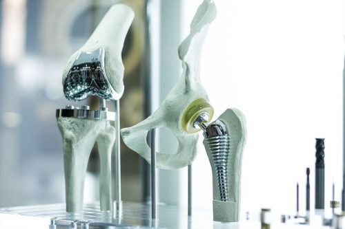 Fehlerhafte Implantation einer Kniegelenksprothese - Schmerzensgeld