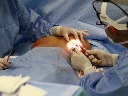 Schmerzensgeldanspruch bei Anfertigung von Lichtbildern während einer Brustoperation