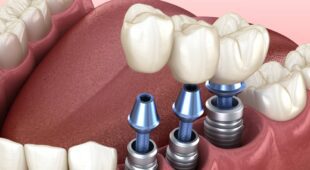 Beihilfefähigkeit eines dritten Zahn-Implantats