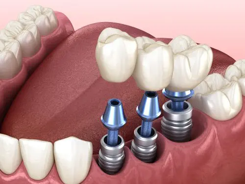 Beihilfefähigkeit eines dritten Zahn-Implantats
